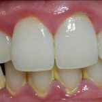 Kako ukloniti kamenac sa zuba: dentalna i prirodna rješenja